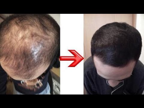 weird ways to regrow hair